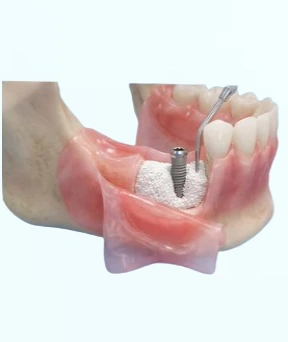 Bone Augmentation