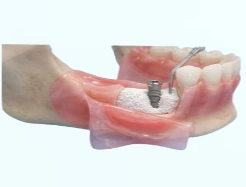 Bone Augmentation