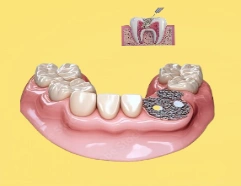 Bone Grafting 2