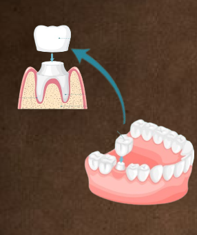 Dental crowns